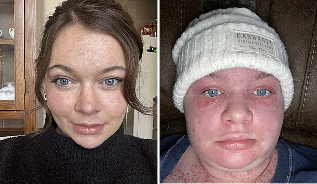 Stačí třicet sekund na slunci a žena má extrémní projevy alergie